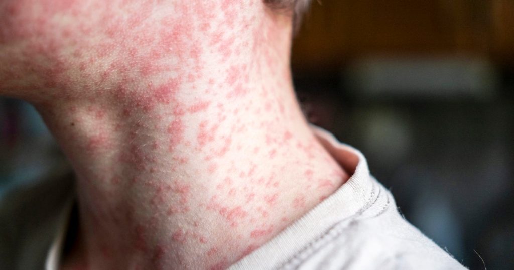 Measles Outbreaks Rise in Kansas and Ohio as U.S. Cases Climb
