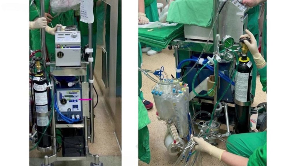 Breakthrough in Transplant Surgery: First Continuous Beating Heart Transplant Performed