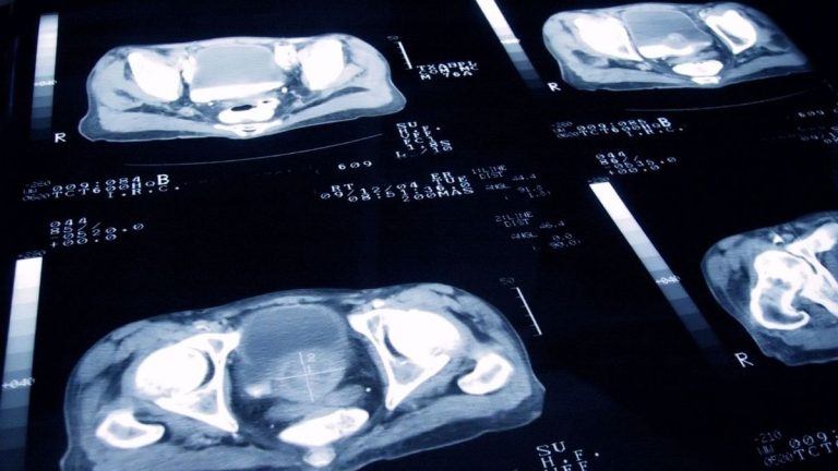 New AI Test Targets Patients for Promising Prostate Cancer Treatment