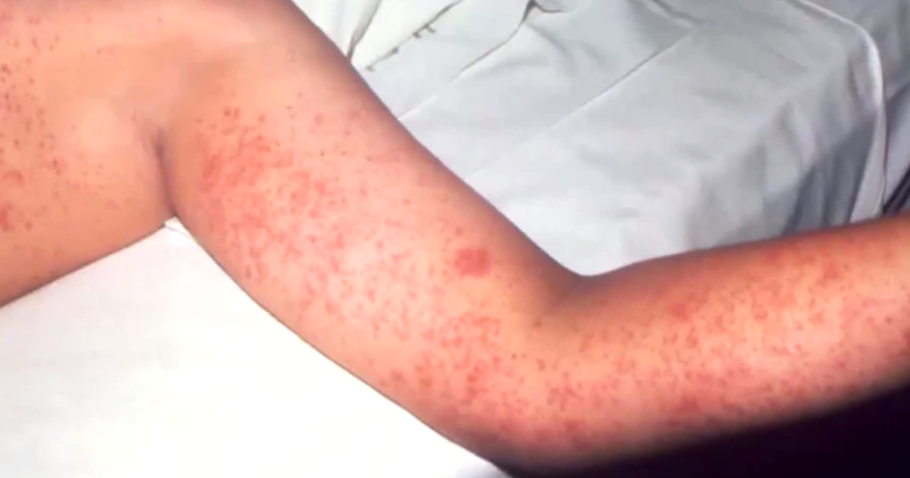Weekly Measles Cases Reach Record High During Worst Outbreak Since the 1990s