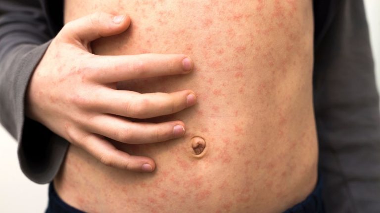 Measles Cases Surge Across Europe Amid Public Health Concerns