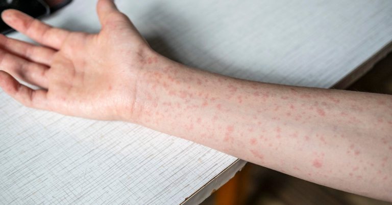 CDC Advises Summer Camps to Verify Measles Immunity Amidst Rising Cases