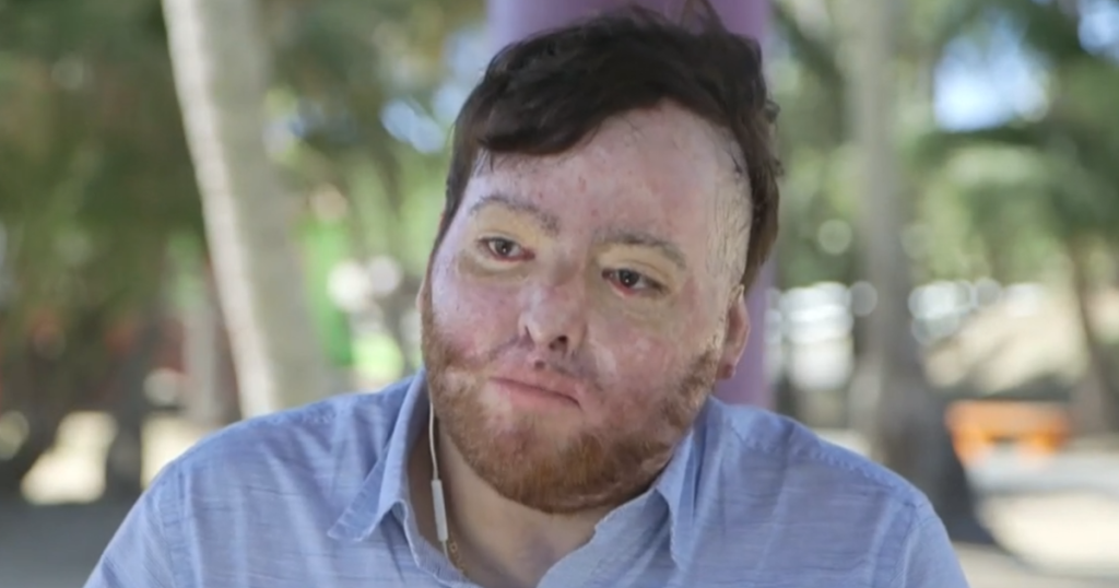 U.S. Citizen Faces $1.7 Million Bill for Essential Burn Treatment