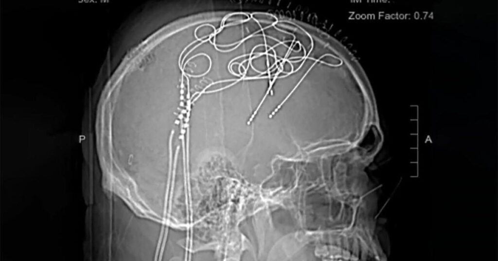 Chronic Pain: Insights and Mysteries Explored by Expert
