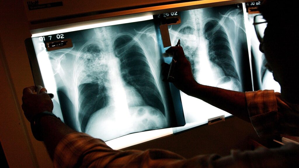 Maine Sees 3 Active TB Cases Amid Global Health Concerns
