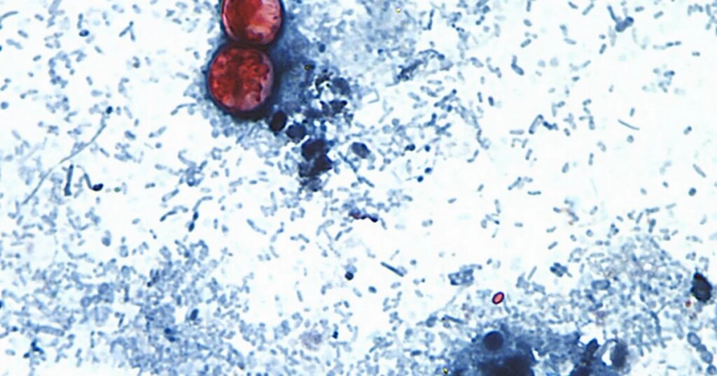 Cyclospora Outbreak from Recalled Iceberg Lettuce Expands to Three More States, FDA Reports